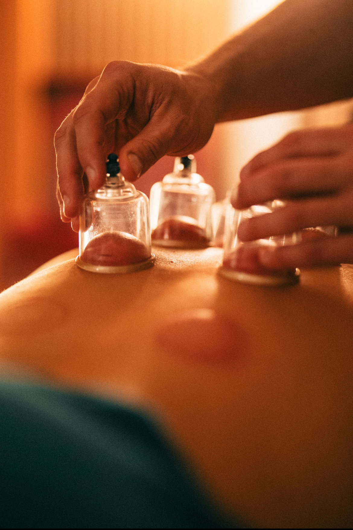 Cupping therapy